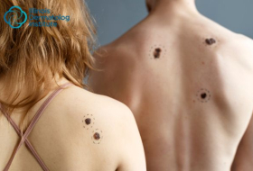 Melanoma: Amplifying Awareness and Advocating for Regular Body Checks