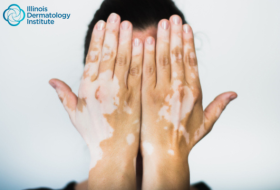 How Can Understanding Vitiligo Help in Better Living?