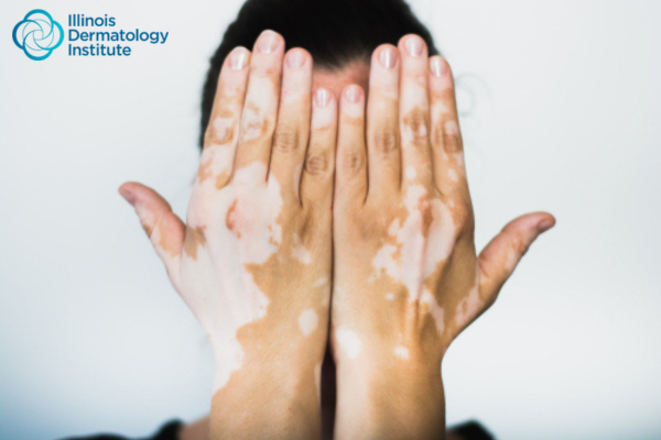 How Can Understanding Vitiligo Help in Better Living?