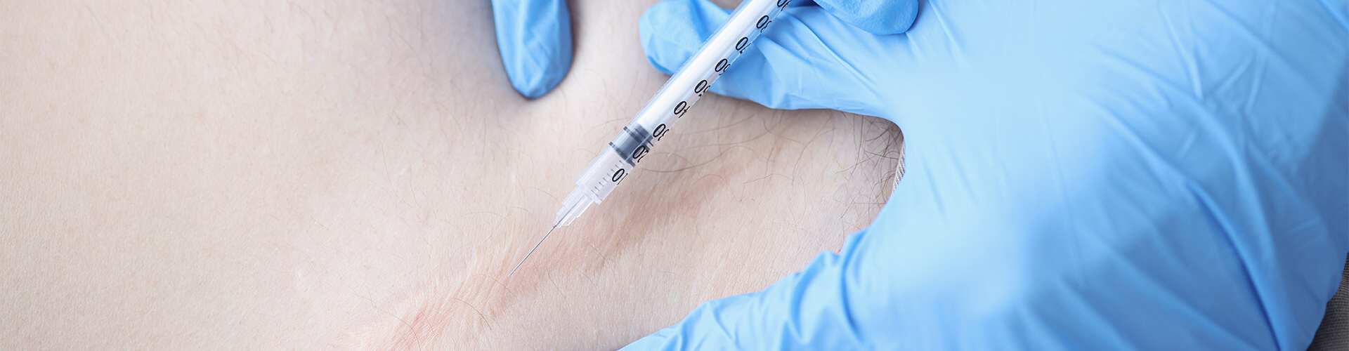 Keloid Scar Treatment