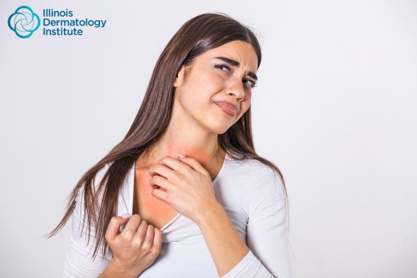 How Long Does a Sunburn Last and How Can You Prevent It?