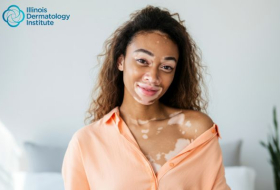 Does Vitiligo Spread? What Dermatologists Want Patients to Know