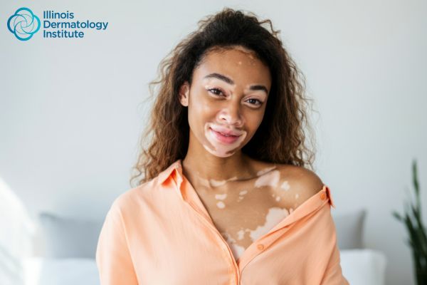 Does Vitiligo Spread? What Dermatologists Want Patients to Know